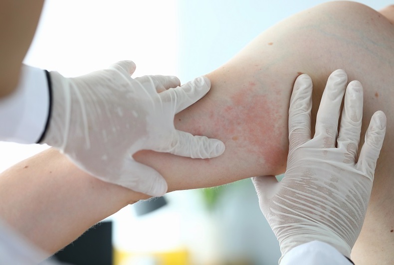 Atopická dermatitida může mít dvě příčiny - buď genetické predispozice, nebo epigenetické faktory, které jsou vázané na životní prostředí a náš životní styl.