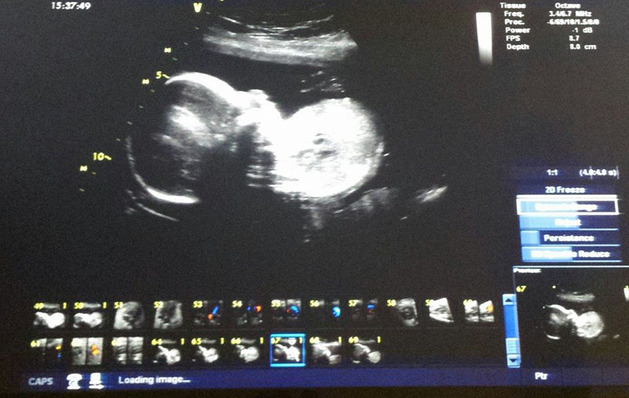 Ultrazvuk prozradil, že to bude holčička.