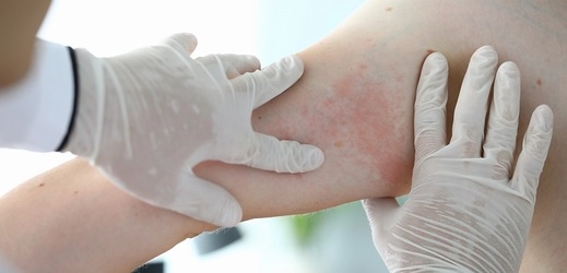 Atopická dermatitida může mít dvě příčiny - buď genetické predispozice, nebo epigenetické faktory, které jsou vázané na životní prostředí a náš životní styl.