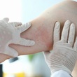 Atopická dermatitida může mít dvě příčiny - buď genetické predispozice, nebo epigenetické faktory, které jsou vázané na životní prostředí a náš životní styl.
