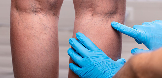 Kdy se začít starat o zdraví svých nohou a žil?