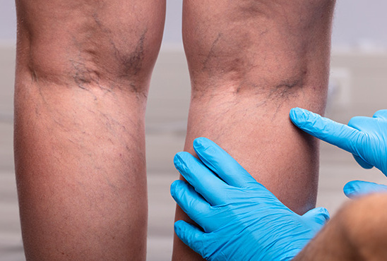 Kdy se začít starat o zdraví svých nohou a žil?